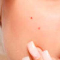 Dark Spots