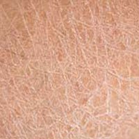 Dry Skin