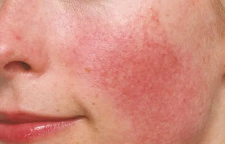 Sensitive Skin