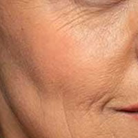 Aging & Fine Lines