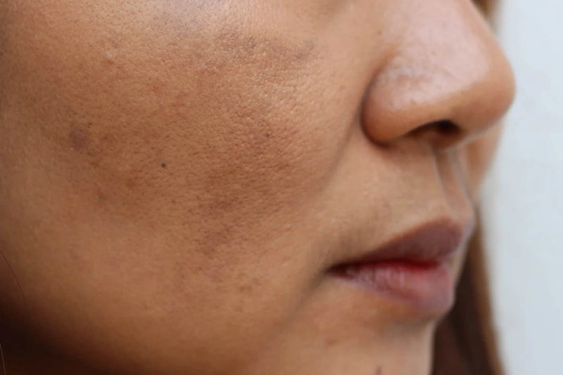 Dull Skin